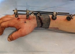 Краснодарские врачи пришили 22-летнему пациенту отрубленную топором кисть.