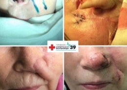 Собака откусила нос женщине, а нижегородские хирурги его восстановили.