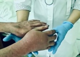Челнинец едва не лишился руки после укуса гадюки