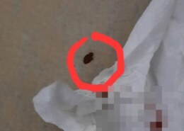 Пациенты новосибирской больницы пожаловались на кусающихся клопов